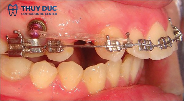 In what cases do braces screws need to be inserted? 2