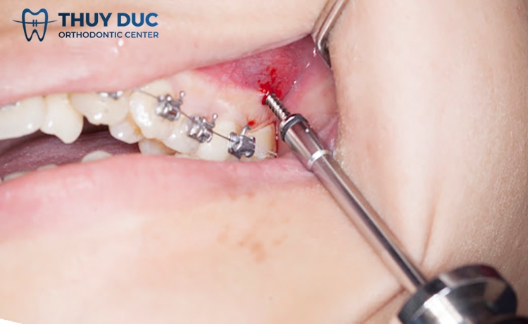 How to fix inflammation when inserting braces screws? 1