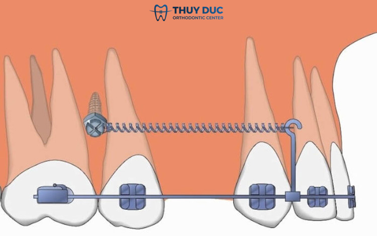 In what cases do braces screws need to be inserted? 1