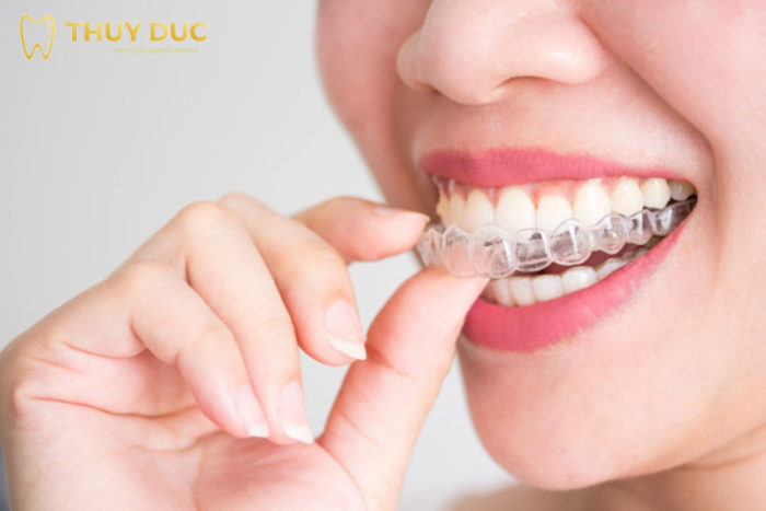 What are Invisalign clear braces? 1