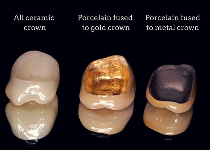 Which type of porcelain tooth should I choose for a porcelain tooth crown? 1