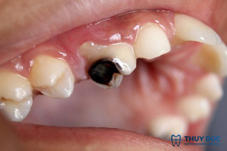 Before porcelain crowns, dental diseases cannot be thoroughly treated 1