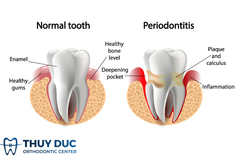 What is periodontitis? 1