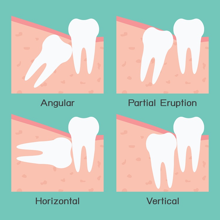 Dangerous complications caused by misaligned and impacted wisdom teeth 1