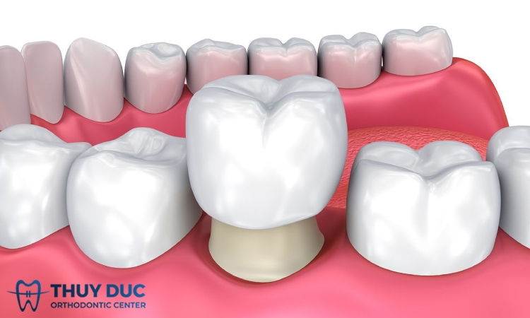 2.1. Grinding teeth, invading real teeth 1