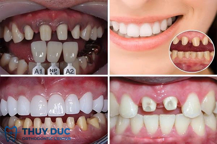 Is it possible to get porcelain crowns a second time?