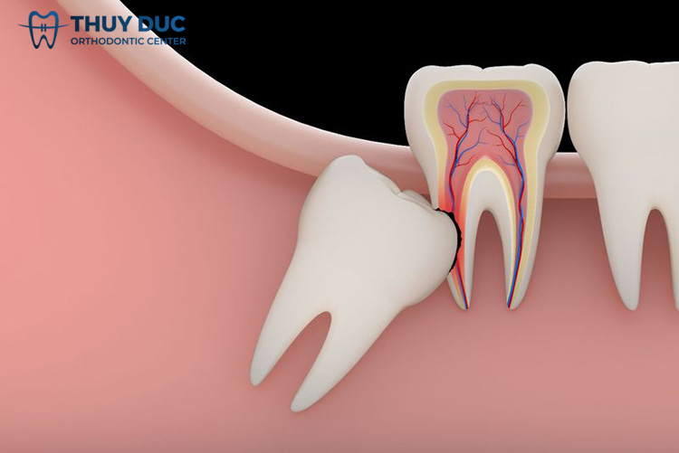 Wisdom teeth that don’t hurt should I be extracted?