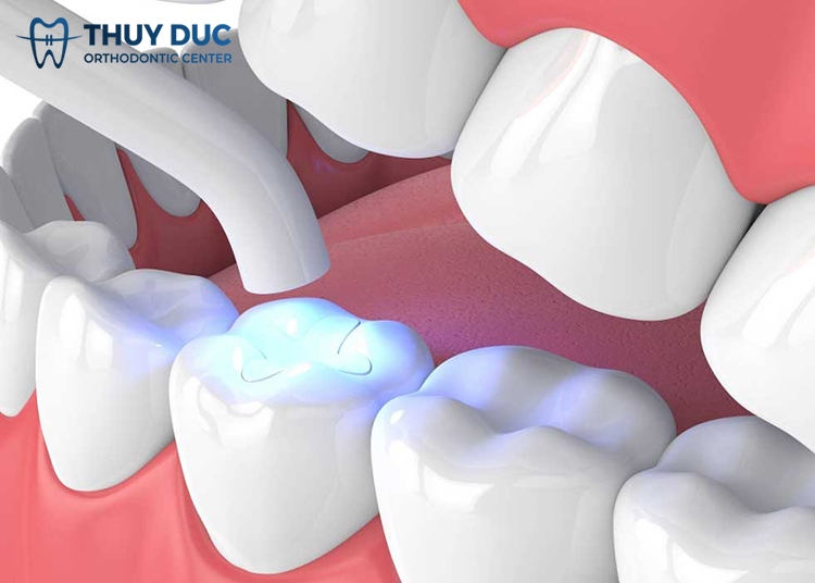 2. Dental filling techniques 1