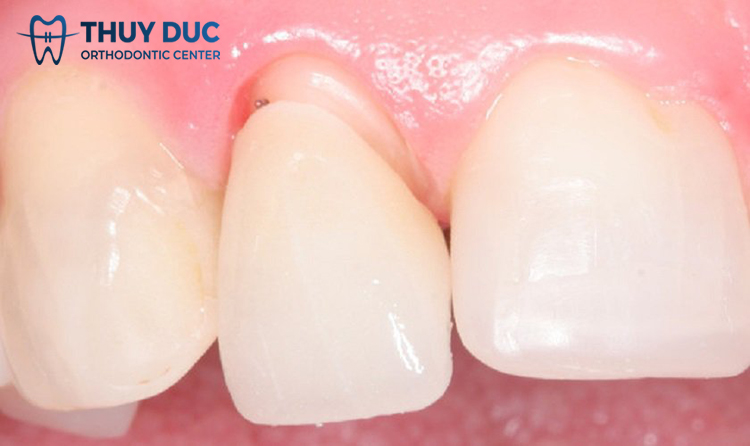 Signs of exposed porcelain teeth and how to fix them