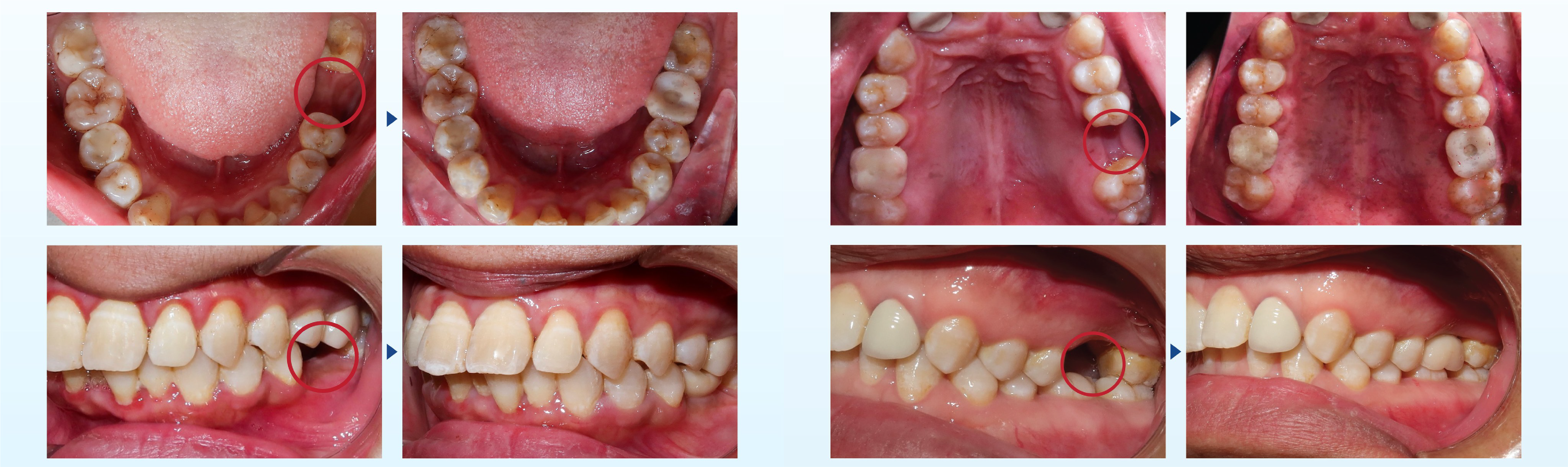 DENTAL IMPLANT TREATMENT AT THUY DUC DENTAL CLINIC 6 DENTAL IMPLANT TREATMENT AT THUY DUC DENTAL CLINIC 6