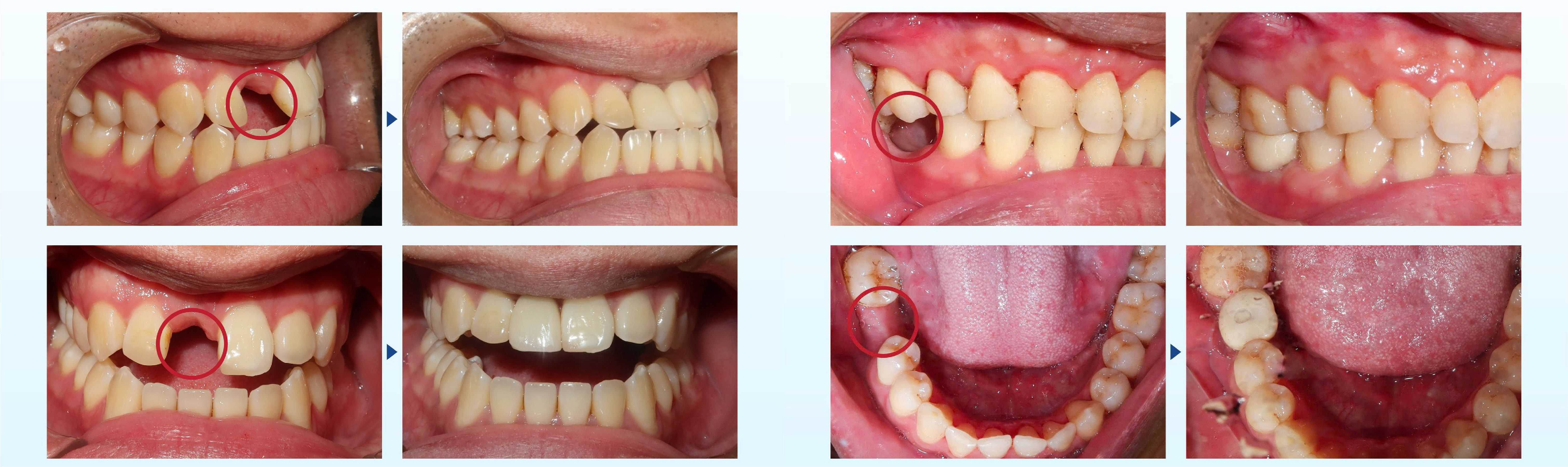 DENTAL IMPLANT TREATMENT AT THUY DUC DENTAL CLINIC 7 DENTAL IMPLANT TREATMENT AT THUY DUC DENTAL CLINIC 7