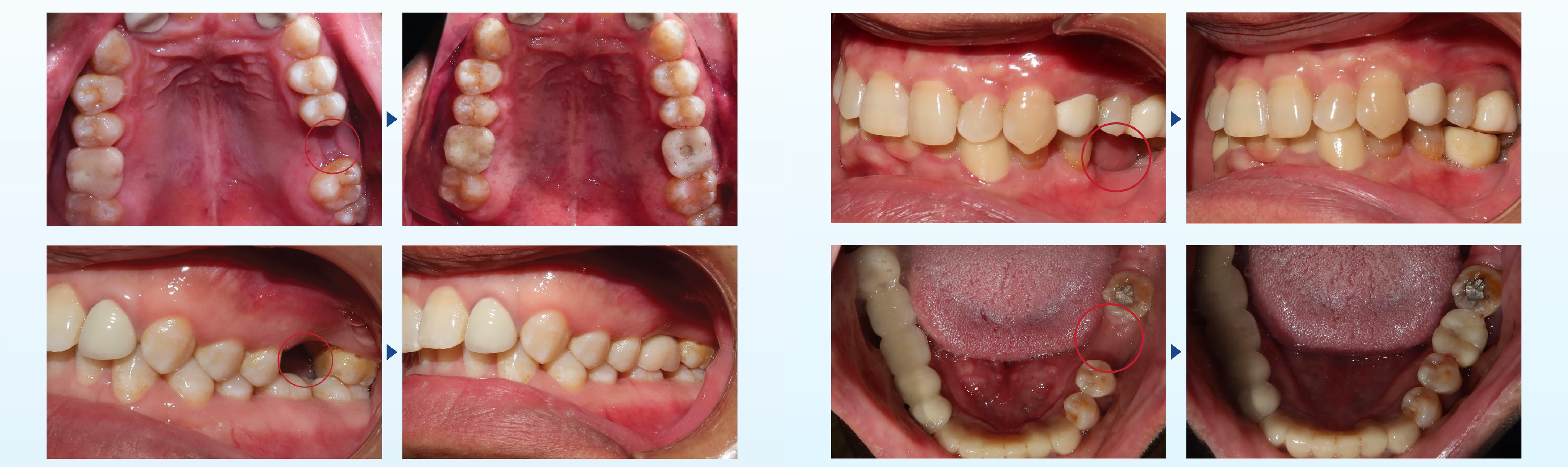 DENTAL IMPLANT TREATMENT AT THUY DUC DENTAL CLINIC 8 DENTAL IMPLANT TREATMENT AT THUY DUC DENTAL CLINIC 8