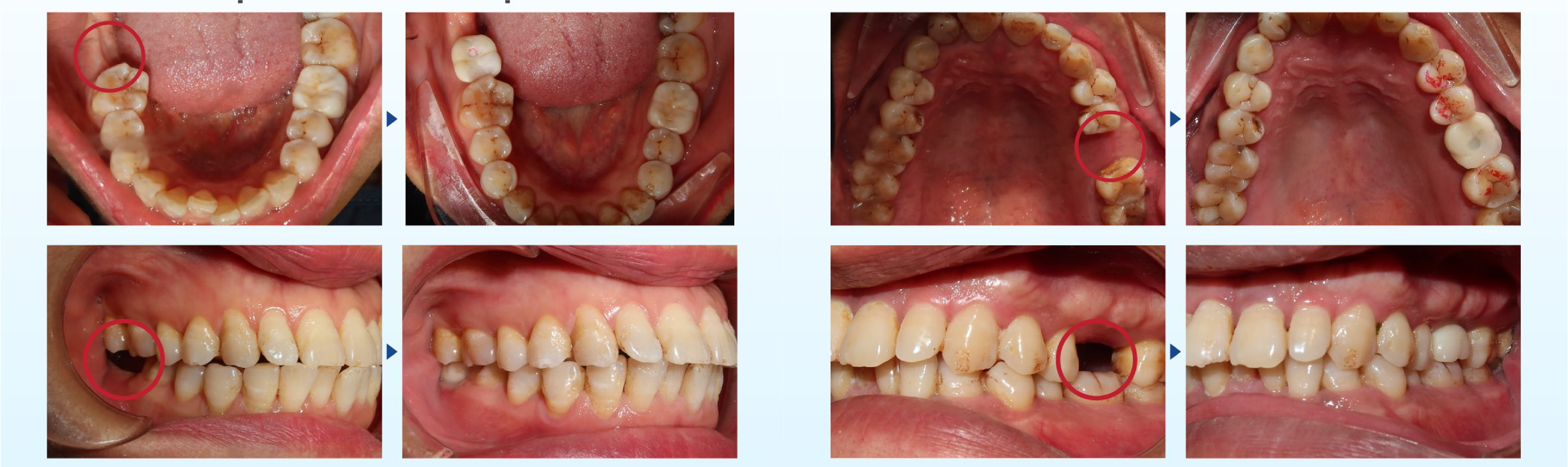 DENTAL IMPLANT TREATMENT AT THUY DUC DENTAL CLINIC 9 DENTAL IMPLANT TREATMENT AT THUY DUC DENTAL CLINIC 9