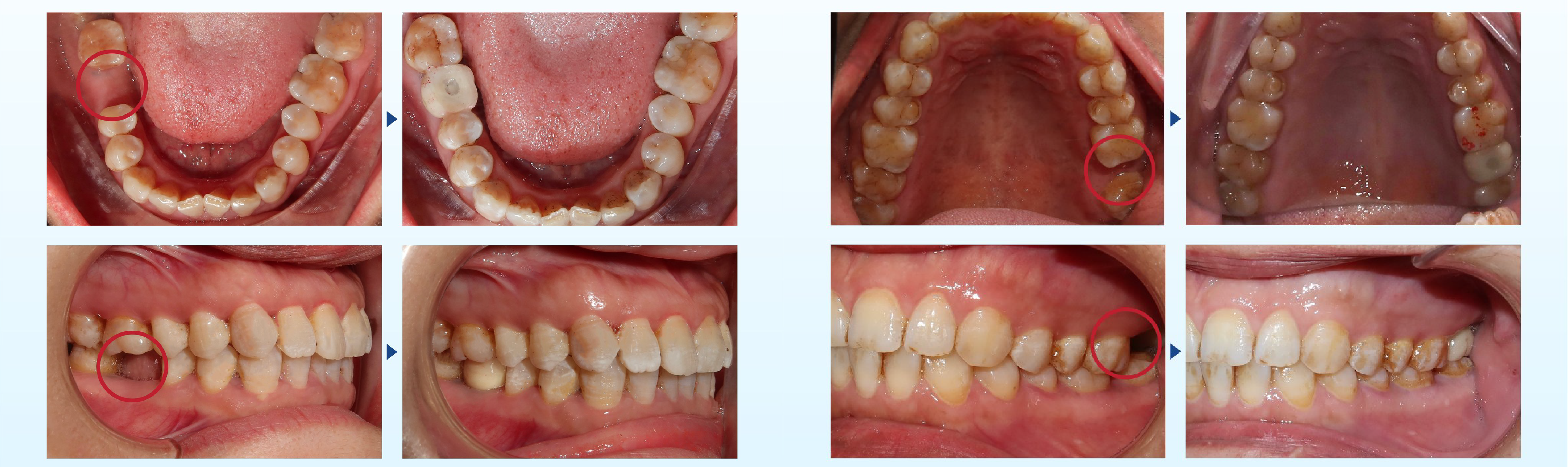 DENTAL IMPLANT TREATMENT AT THUY DUC DENTAL CLINIC 10 DENTAL IMPLANT TREATMENT AT THUY DUC DENTAL CLINIC 10