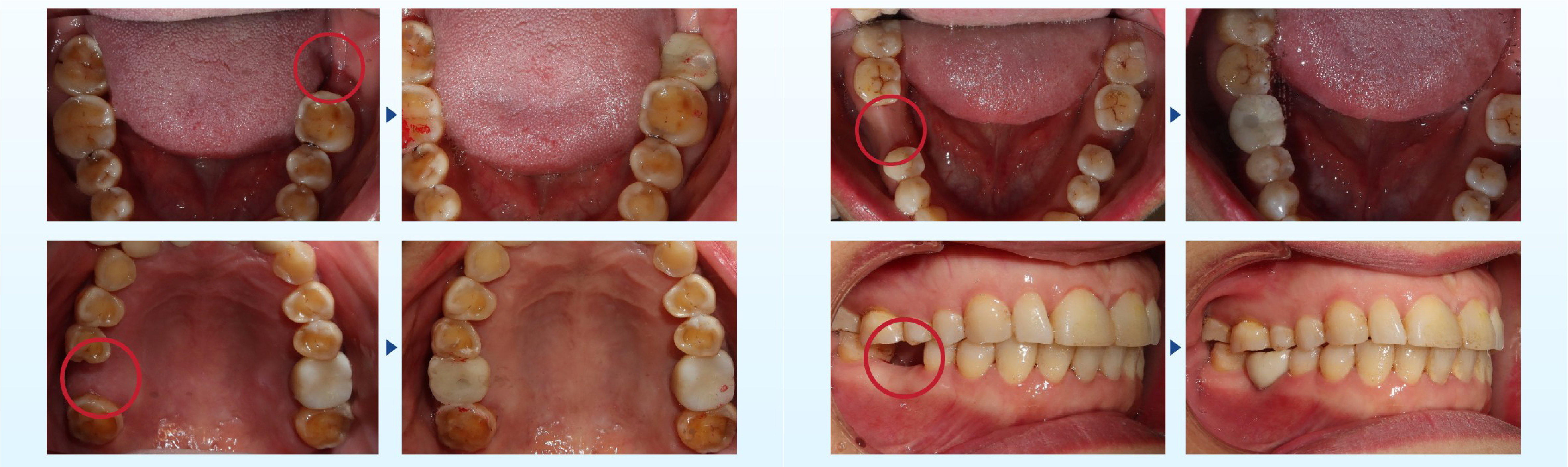 DENTAL IMPLANT TREATMENT AT THUY DUC DENTAL CLINIC 11 DENTAL IMPLANT TREATMENT AT THUY DUC DENTAL CLINIC 11